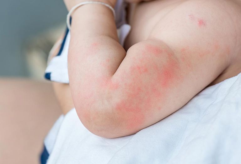 Trẻ bị nổi mề đay tắm lá gì cho an toàn và hiệu quả