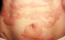 nổi mề đay ở lưng, bụng