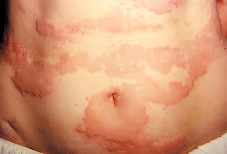 nổi mề đay ở lưng, bụng