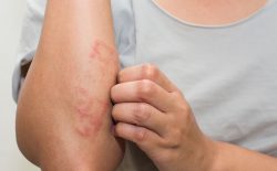 Vảy nến có ngứa không