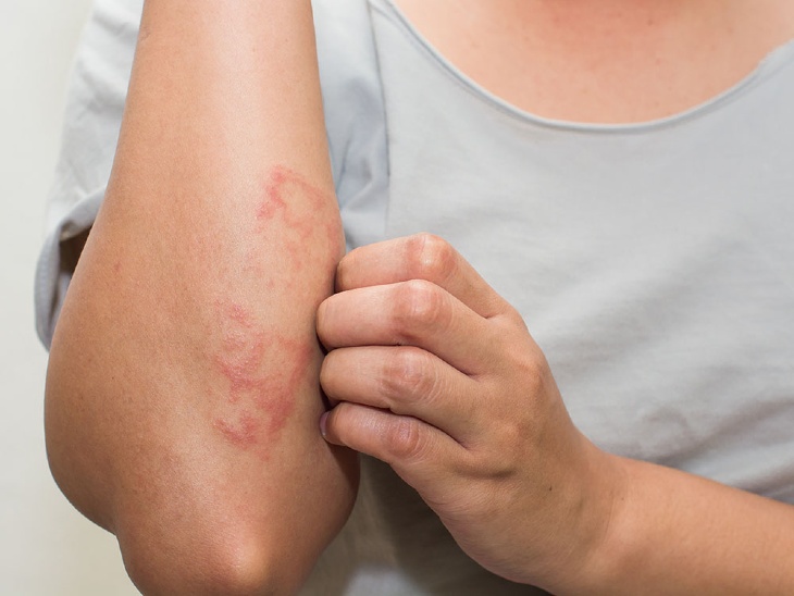 Vảy nến có ngứa không
