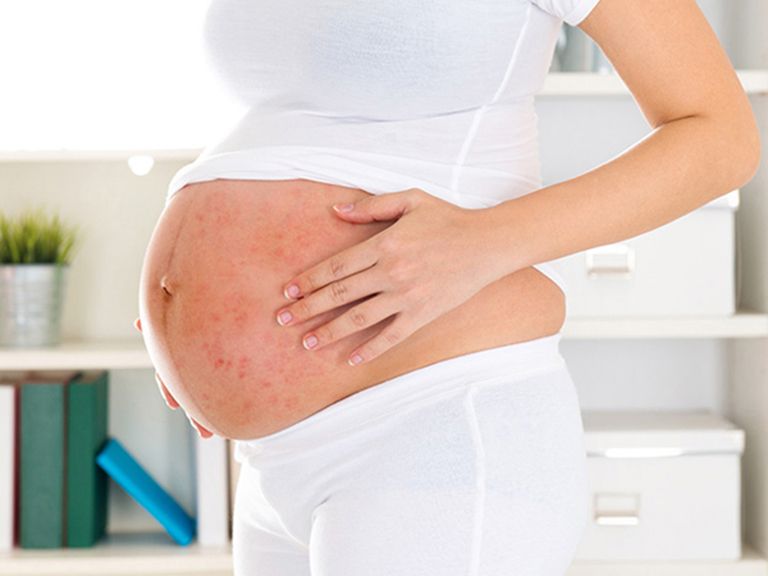 Bà bầu bị nổi mẩn đỏ ở bụng không ngứa: Mẹ không được chủ quan
