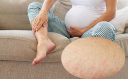 bà bầu bị nổi mẩn ngứa ở chân