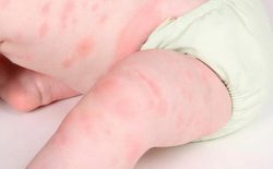 Bé nổi mẩn đỏ khắp người sau sốt: Mẹ đừng chủ quan, biến chứng khôn lường