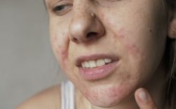 Da mặt khô ngứa mẩn đỏ do đâu? Bật mí cách chữa hiệu quả, ngăn tái phát