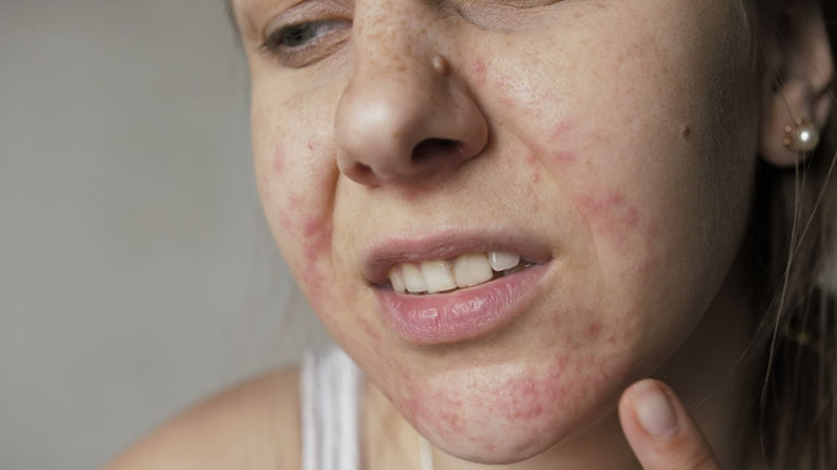 Da mặt khô ngứa mẩn đỏ do đâu? Bật mí cách chữa hiệu quả, ngăn tái phát