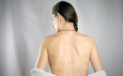 nổi mẩn ngứa khắp người