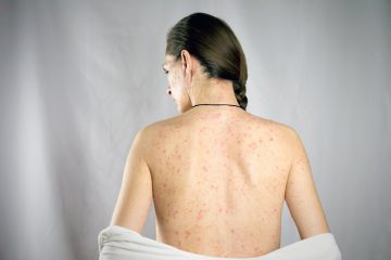 nổi mẩn ngứa khắp người