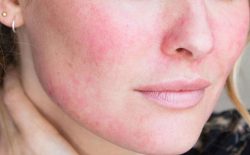 Mặt nổi mẩn đỏ không ngứa: Điều trị đúng cách, tránh biến chứng về sau