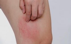 Nổi mẩn đỏ ngứa ở chân là bị bệnh gì? Cách điều trị dứt điểm