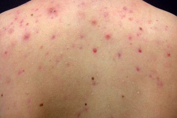 Nổi mẩn đỏ ở lưng không ngứa và những bệnh lý tiềm ẩn chớ chủ quan