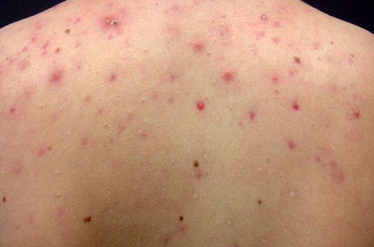 Nổi mẩn đỏ ở lưng không ngứa và những bệnh lý tiềm ẩn chớ chủ quan
