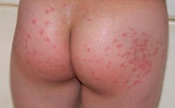 Nổi mẩn đỏ ở mông nhưng không ngứa: Biện pháp chữa trị dứt điểm