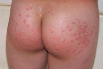 Nổi mẩn đỏ ở mông nhưng không ngứa: Biện pháp chữa trị dứt điểm