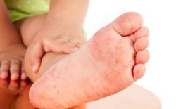 Nổi mẩn ngứa ở chân cảnh báo bệnh lý gì? Cách trị dứt điểm, ngăn tái phát