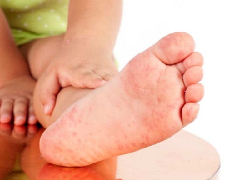 Nổi mẩn ngứa ở chân cảnh báo bệnh lý gì? Cách trị dứt điểm, ngăn tái phát