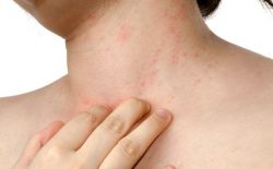Nổi mẩn ngứa ở cổ: Cách chữa trị hiệu quả lâu dài, không tái phát