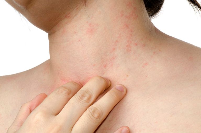 Nổi mẩn ngứa ở cổ: Cách chữa trị hiệu quả lâu dài, không tái phát