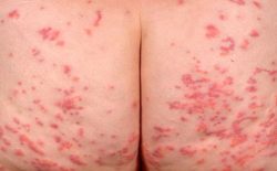 Nổi mẩn ngứa ở mông cảnh báo bệnh gì? Cách chữa trị hiệu quả dứt điểm