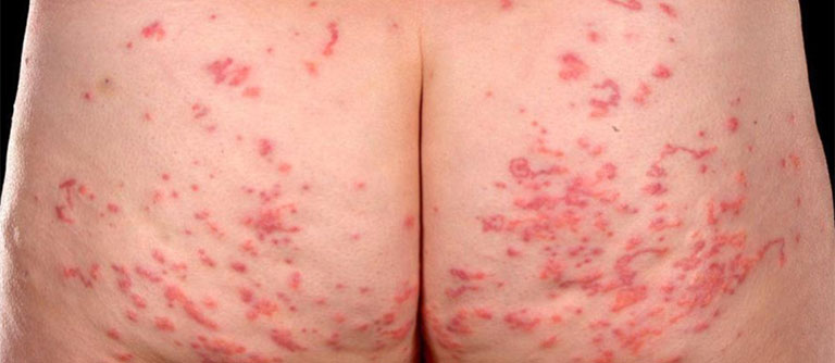Nổi mẩn ngứa ở mông cảnh báo bệnh gì? Cách chữa trị hiệu quả dứt điểm