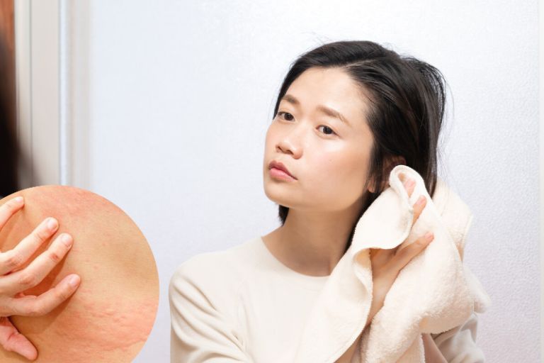 Phương pháp xử lý nổi mẩn ngứa sau khi tắm hiệu quả, an toàn