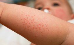 Trẻ sơ sinh bị nổi mẩn đỏ ở chân và những điều mẹ cần biết
