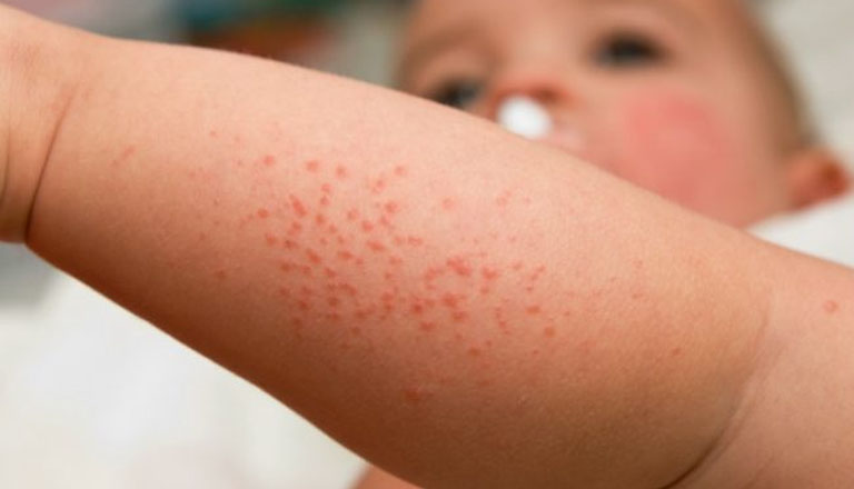 Trẻ sơ sinh bị nổi mẩn đỏ ở chân và những điều mẹ cần biết