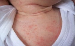 trẻ sơ sinh bị mẩn ngứa
