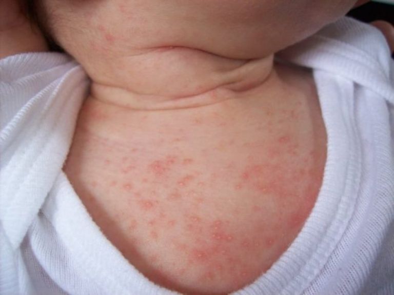 trẻ sơ sinh bị mẩn ngứa