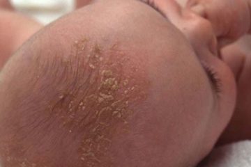 Trẻ sơ sinh bị nổi mẩn đỏ ở đầu: Cha mẹ cần làm gì?