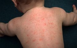 Trẻ sơ sinh bị nổi mẩn đỏ ở lưng – Hiểu đúng bệnh, trị đúng cách