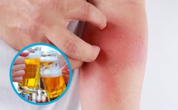 Uống Rượu Nổi Mề Đay Có Sao Không? Cách Khắc Phục Hiệu Quả, An Toàn