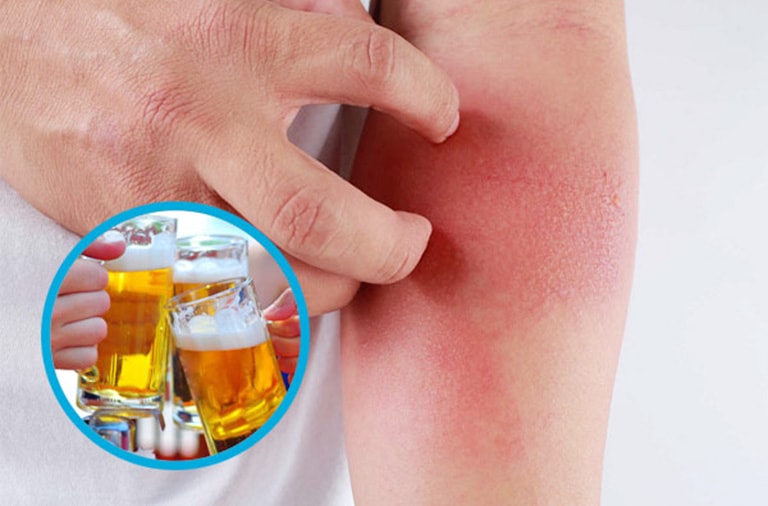 Uống Rượu Nổi Mề Đay Có Sao Không? Cách Khắc Phục Hiệu Quả, An Toàn