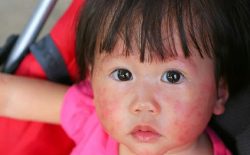 Hình ảnh á sừng ở trẻ