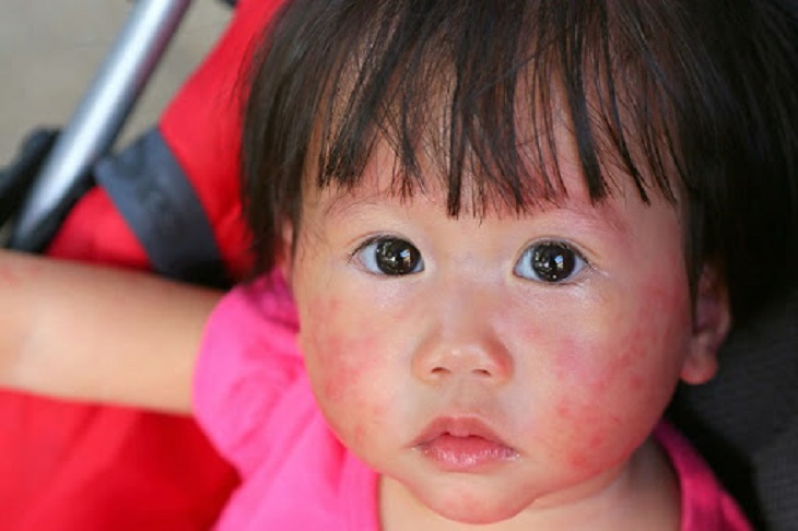 Hình ảnh á sừng ở trẻ