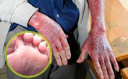 Sớm nhận biết biểu hiện bệnh ngăn ngừa biến chứng