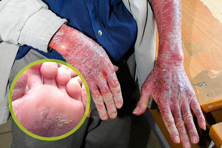 Sớm nhận biết biểu hiện bệnh ngăn ngừa biến chứng