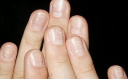 Vảy nến móng tay là bệnh lành tính nhưng gây mất thẩm mỹ