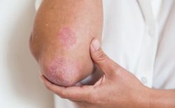 Cách trị Eczema bằng củ quả tốt nhất
