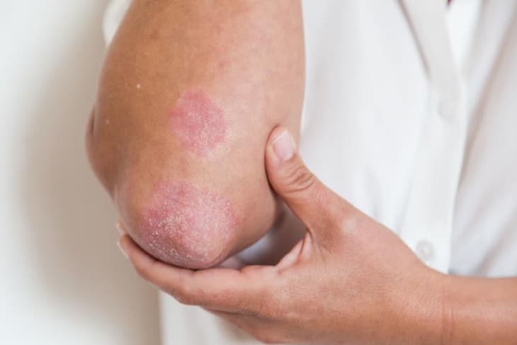 Cách trị Eczema bằng củ quả tốt nhất