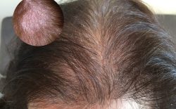 Hình ảnh bệnh á sừng da đầu