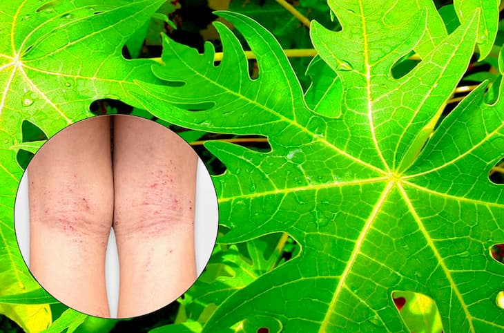Lưu ý cần rửa sạch và áp dụng kiên trì trong điều trị