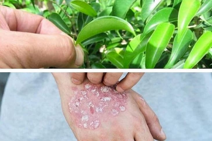 Trị Eczema bằng lá móng tay như thế nào?