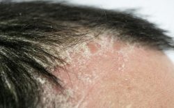 Hình ảnh vảy nến da đầu