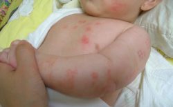Hình ảnh vảy nến ở trẻ