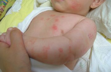 Hình ảnh vảy nến ở trẻ