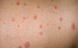 Hình ảnh vảy nến thể giọt