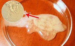 Tinh trùng yếu do đâu? Dấu hiệu nhận biết và cách điều trị triệt để