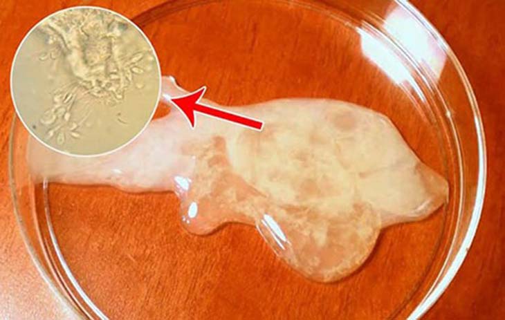 Tinh trùng yếu do đâu? Dấu hiệu nhận biết và cách điều trị triệt để