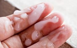 Tinh trùng vón cục: Nguyên nhân, triệu chứng và cách điều trị